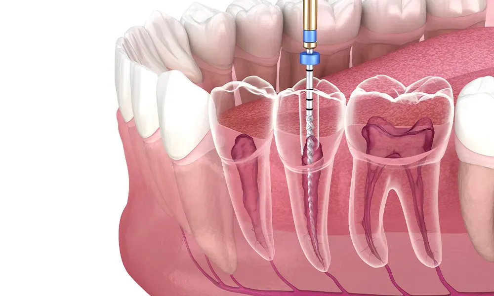 Root Canal Issues